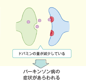 パーキンソン病の場合