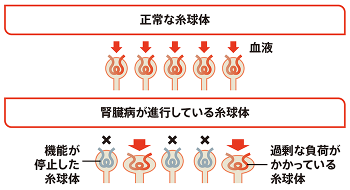 慢性腎臓病（CKD）が進行するとどうなるの