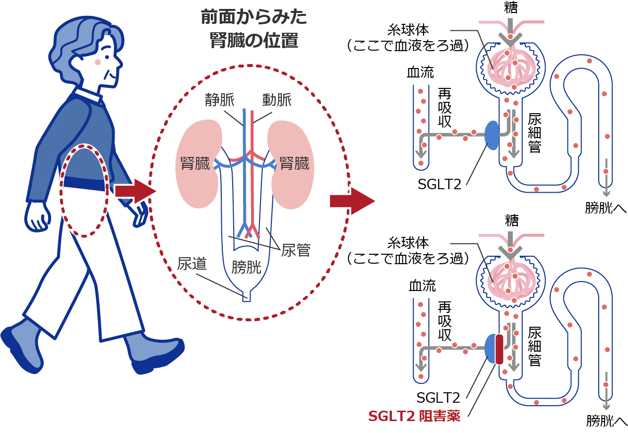 フォシーガ錠の働きについて