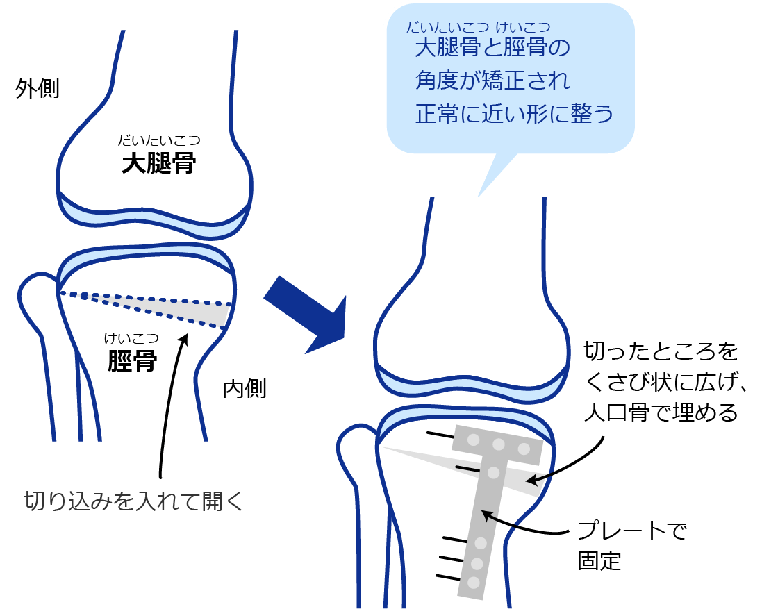 大腿骨と脛骨の角度が矯正され正常に近い形に整う