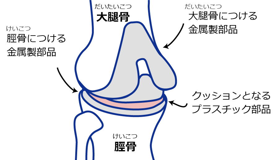 大腿骨と脛骨のイラスト